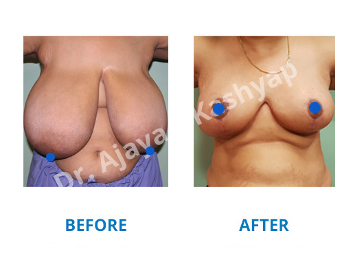 breast reduction surgery in gurugram