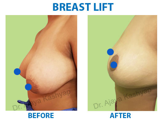 breast lift surgery in gurugram