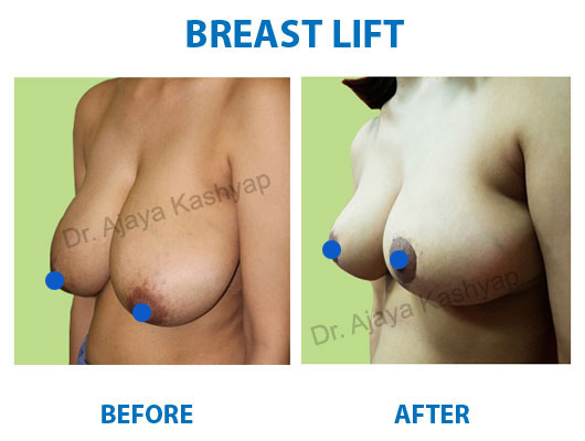 breast lift cost in india