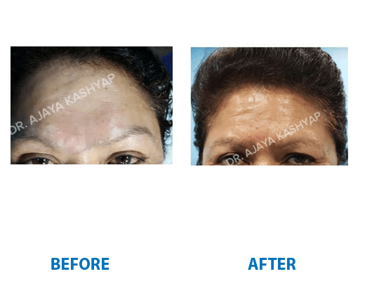 Forehead reduction cost in india