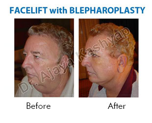 Facelift with Blepharoplasty in india
