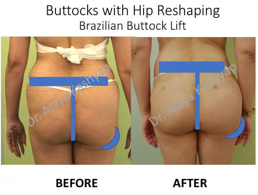 BBL with body shaping