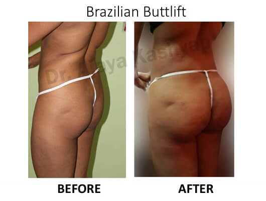 brazilian butt lift surgery in gurugram