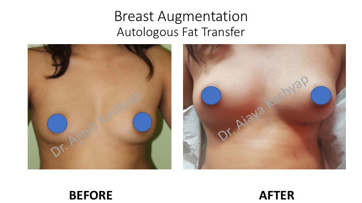 autologous fat transfer surgery in delhi