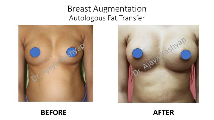 autologous fat transfer for breast surgery