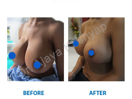breast reduction cost in india