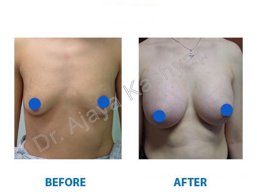 breast enlargement surgery in gurugram