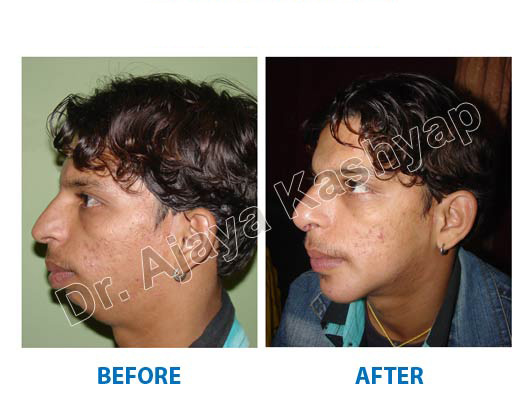 Chin Augmentation surgery in gurugram