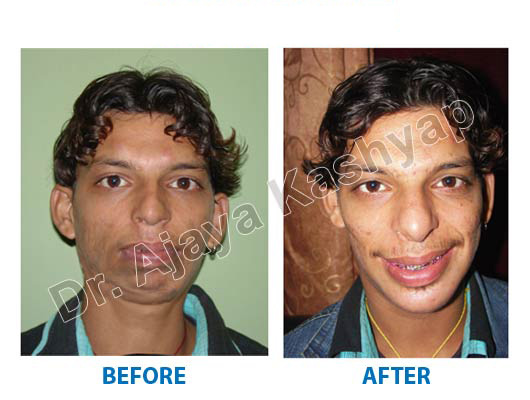 chin implant cost in india
