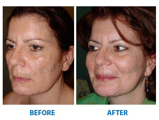 facelift cost in india