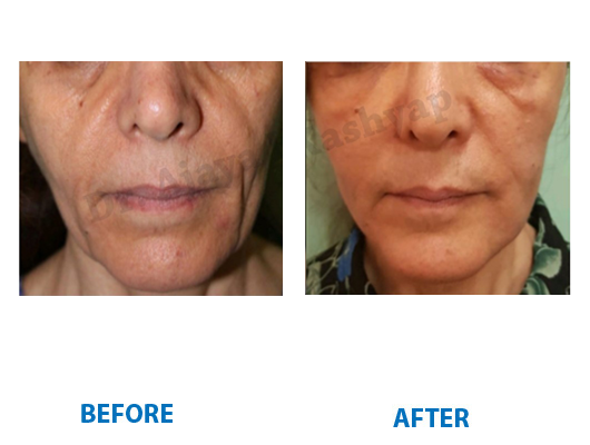 facial fat transfer