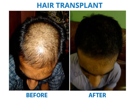 hair transplant