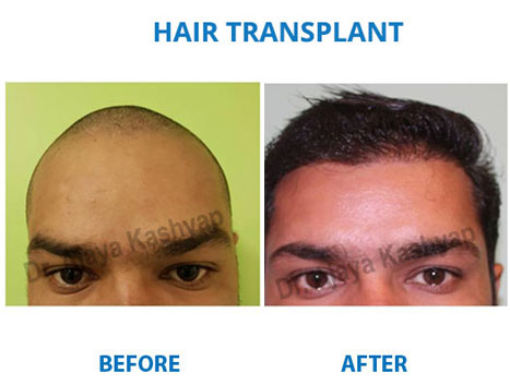 hair transplant doctor