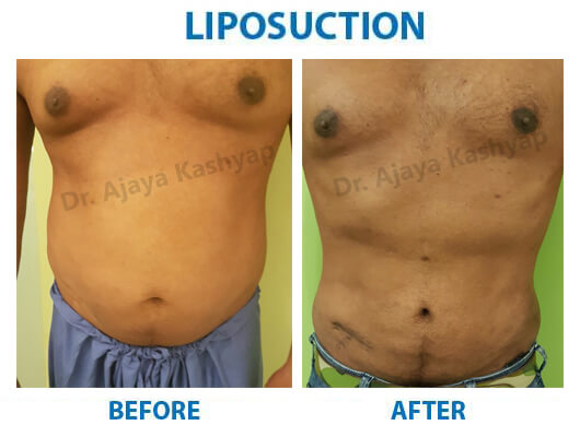 liposuction india