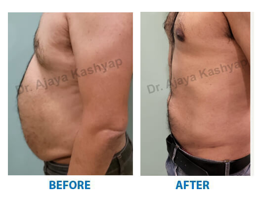 liposuction india