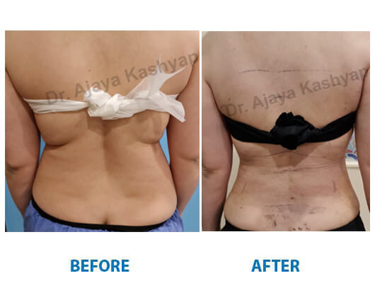 liposuction surgeon delhi