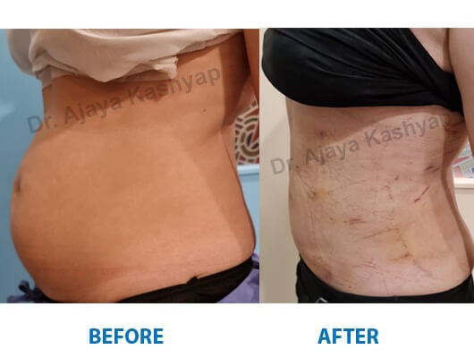 liposuction clinic delhi