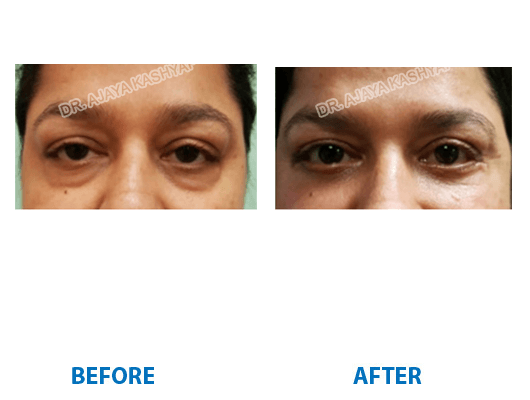 eyelid surgery in gurugram