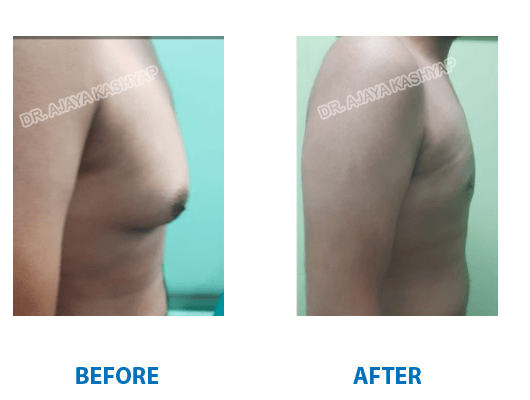 male breast reduction surgery in gurugram
