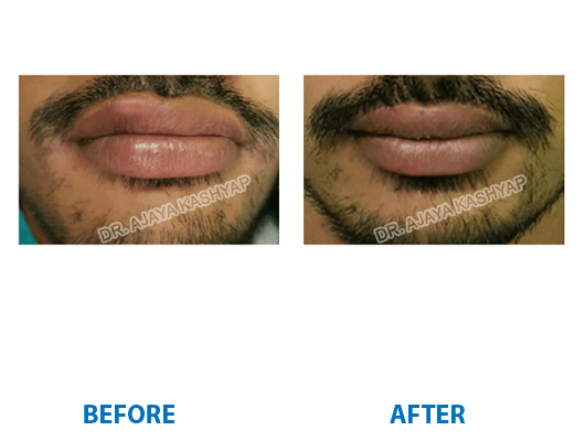 lip reduction in gurugram