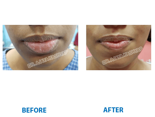 lip reduction surgery in south delhi