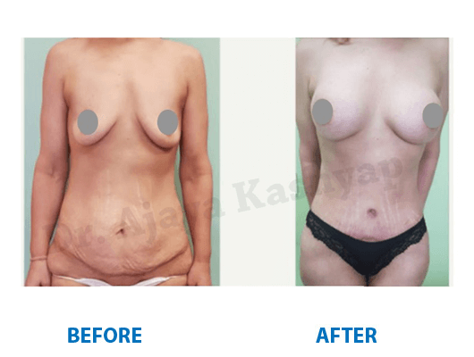mommy makeover procedure in india