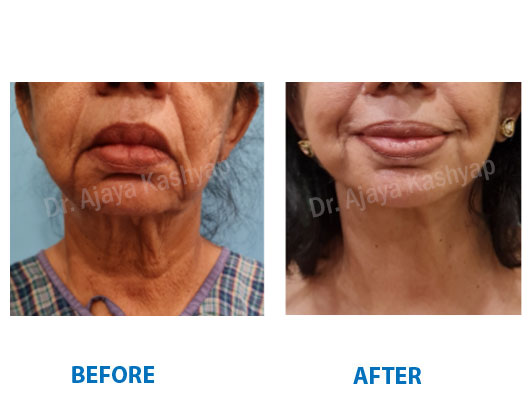 neck lift cost in india
