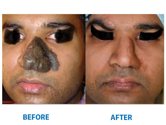 rhinoplasty surgery in india