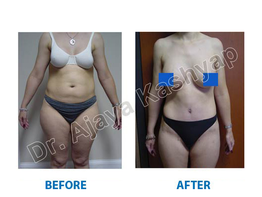 total-body-contouring