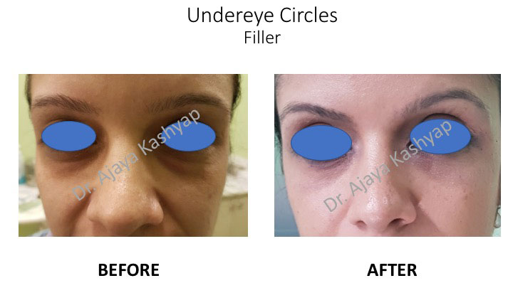 dark under eye circles treatment in delhi