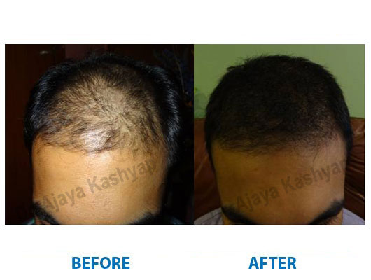 hair transplant clinic in gurugram