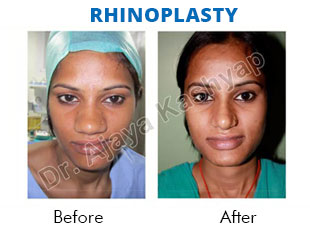 rhinoplasty surgery india