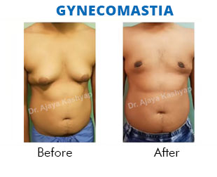 gynecomastia surgery india