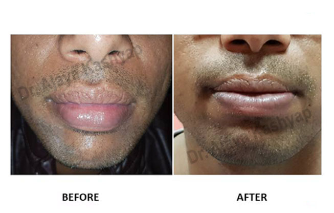 lip reduction surgery in india